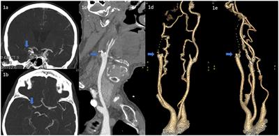 Direct dotterising or angioplasty of acute stroke due to tandem atherosclerotic occlusions